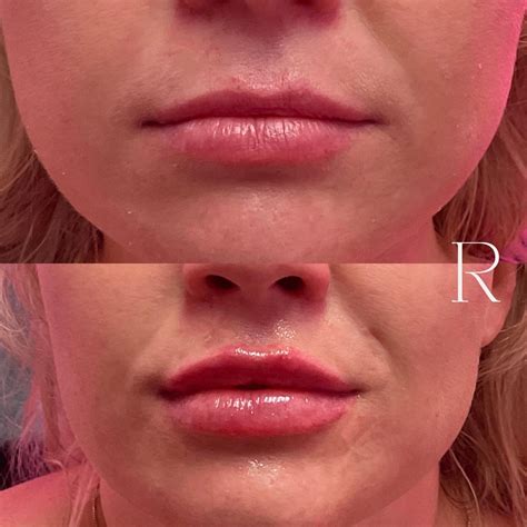 RHA Fillers in Lebanon | Restoration Wellness and Medspa