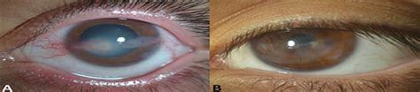 Pediatric Phlyctenular Keratoconjunctivitis at a Tertiary Ca... : Cornea