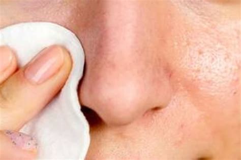 5 Safest Home Remedies to Remove Blackheads