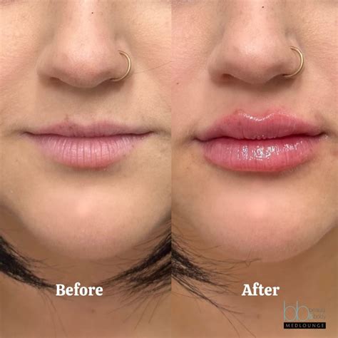 Lip Fillers San Diego, Solana Beach | Beauty and Body Medlounge