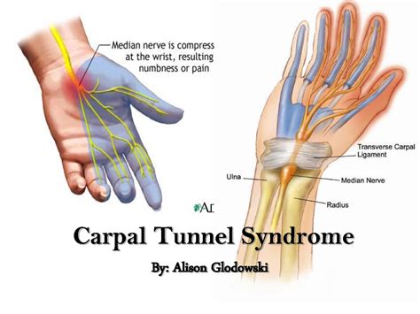 Carpal Tunnel Syndrome – Definition and Treatment - All in All News