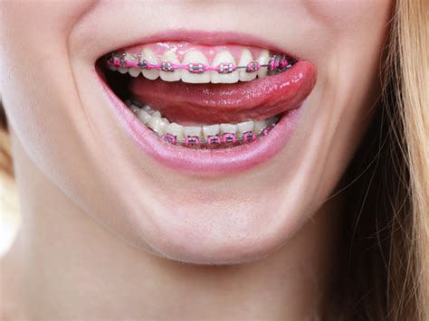 What Do Braces Feel Like? - Roberts & de Marsche