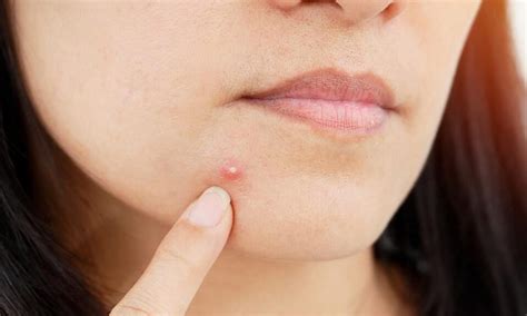 Pimples: Causes, Treatments and Home Remedies - Sentinelassam
