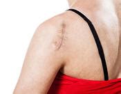 7 Things to Expect After Reverse Shoulder Replacement Surgery