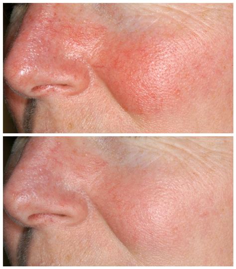 Rosacea Treatments That Actually Work - Zwivel