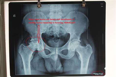 Hip Replacement Alternatives – Hip Replacement Option