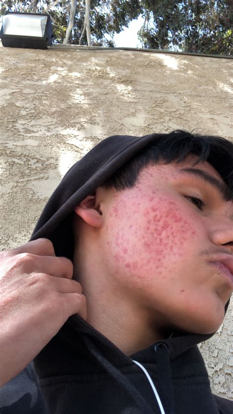 Severe acne scarring :( - Scar treatments - Acne.org