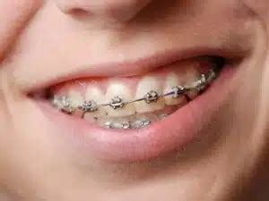 5 Tips To Follow After Getting Metal Braces Treatment