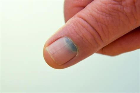 Nail melanoma: prevention and early diagnosis | Emergency Live