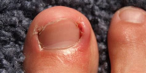 How to Prevent and Treat Ingrown Toenails - Foot And Ankle