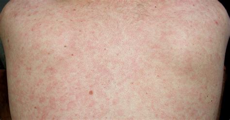 Hiv Rash On Face How To Identify An Hiv Rash Youtube - vrogue.co