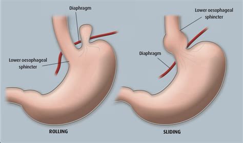 Should I get my hiatus hernia fixed? - Melbourne Gastro Surgery