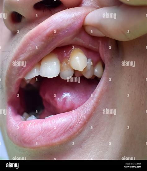 Tooth displacement hi-res stock photography and images - Alamy