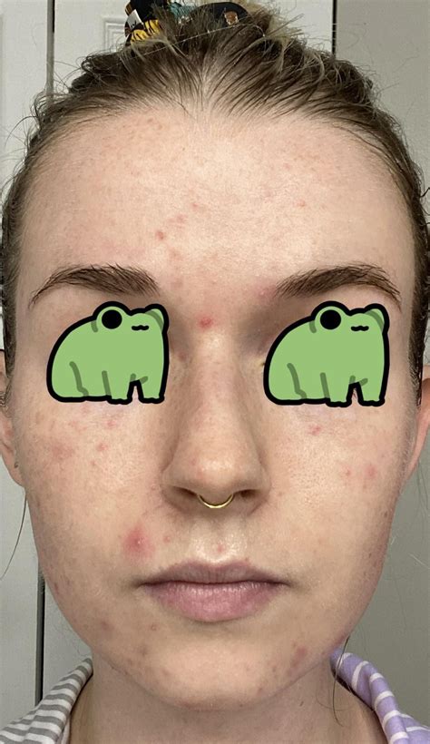 Could this be an overgrowth of dermodex mites? : r/Rosacea