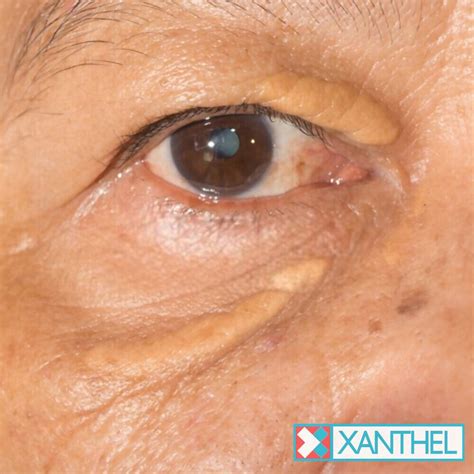 Eyelid Xanthomas - Xanthelasma Treatment