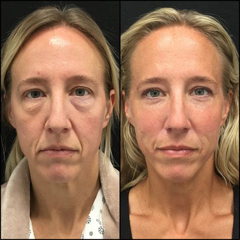 Lower Blepharoplasty Before & After Photos | Flora Levin MD