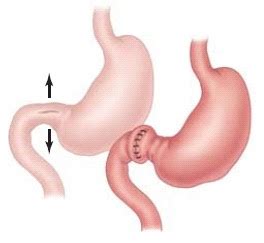 Pyloromyotomy Procedure Steps, Complications, Side effects, Care ...