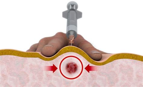 Trigger Point Injections - Center For Joint Health