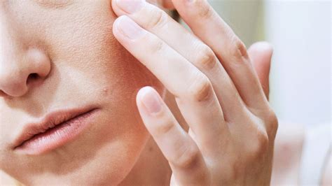 Facial Eczema: Dermatologists on How to Treat, Manage, and Prevent It ...