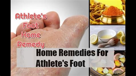 athlete's foot home remedy | home remedies for athletes foot - YouTube