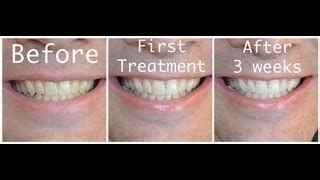 Hydrogen Peroxide Teeth Before And After