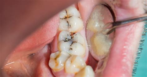 Redefining the Future of Health Services: Hyperdontia Causes Symptoms Prevention And Treatment