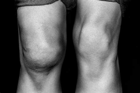 What are the Most Common Causes of Hip and Knee Pain?