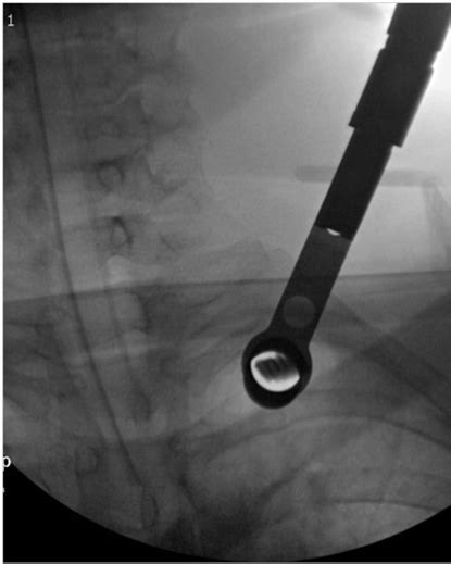 Minimally Invasive Removal of Shrapnel Using a Tubular Retractor System | Surgical Case Reports ...