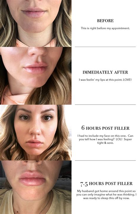 1 5ml Lip Filler Before And After Thin Lips | Lipstutorial.org