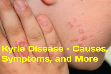 Kyrle Disease – Causes, Symptoms, and More