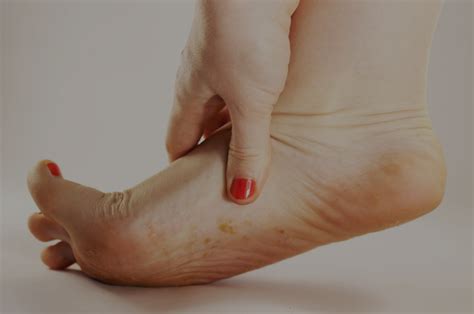 Foot Eczema vs Athlete's Foot