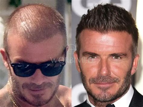 David Beckham Hair Transplant | Before and After