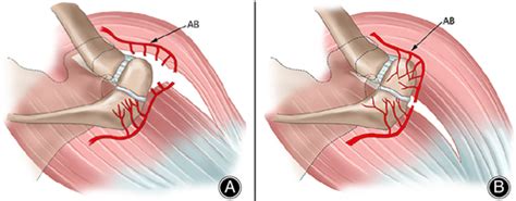 Os Acromiale: Reviews and Current Perspectives - You - 2019 - Orthopaedic Surgery - Wiley Online ...