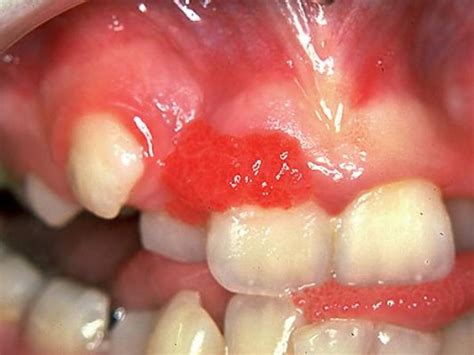 Peripheral Ossifying Fibroma – Exodontia