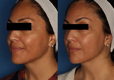 Patient 146621880 | HALO® Laser by Sciton Gallery Before & After Photos ...