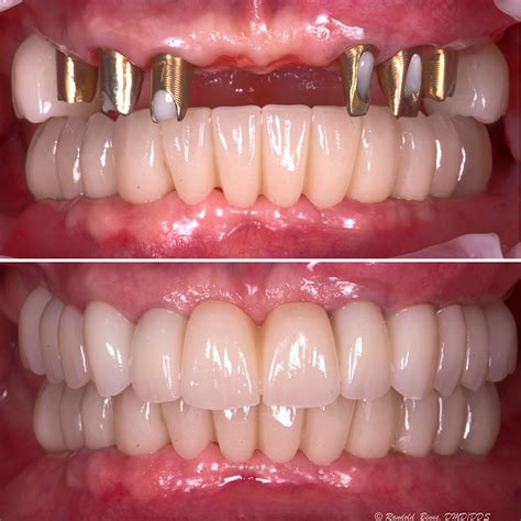 Before & After - Advanced Prosthodontics & Implant Aesthetics | Naples FL