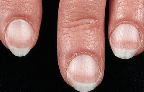 Nail Signs Apparent Leukonychia 表相白甲 - TANGS CLINICAL TCM