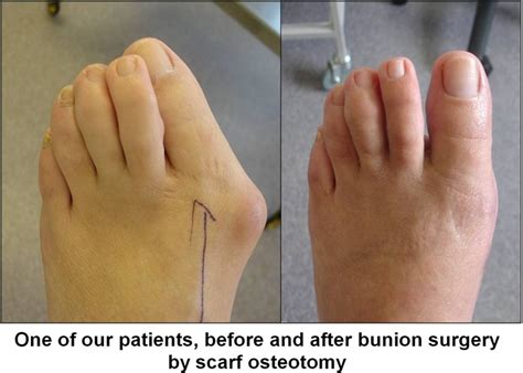 Tailors Bunion Surgery Scar