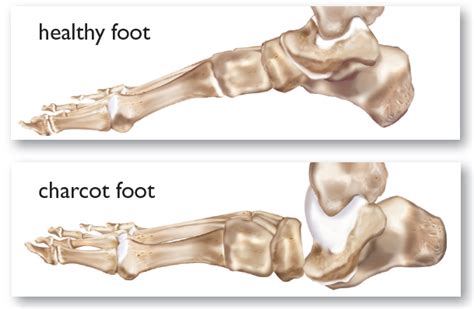 Complications with Charcot Foot | International Orthotic Labs Inc.