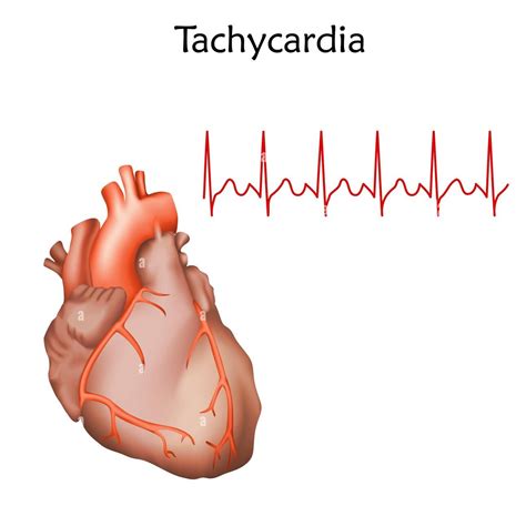 Qu'est-Ce Que La Palpitation Cardiaque (Tachycardie) ? - Turkey ...