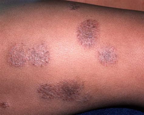 Foods As Eczema Triggers - The Facts & Myths Explained - FoodsNG