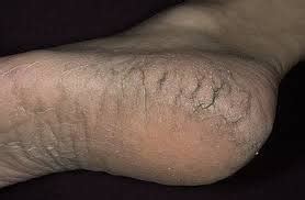 Dry Cracked Feet Causes, Home Remedies, How to Heal, Get Rid of Dry Cracked Feet