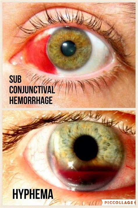 Subconjunctival hemorrhage v. Hyphema #NaturalHomeRemediesForCold in ...