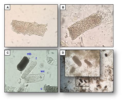 Urine Sediment of the Month: Granular & "Muddy Brown" Casts - Renal ...