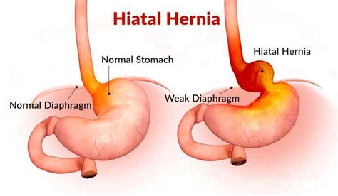 HIATAL HERNIA – CSF Surgery