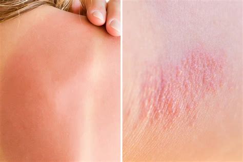 Heat Rash or Sunburn: Here’s How to Tell the Difference | Reader's Digest