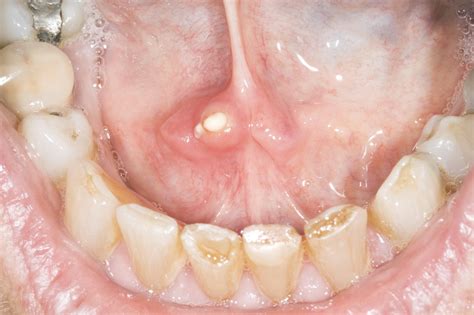 Salivary gland stones - NHS