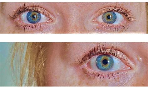 Central Heterochromia: Definition, Causes, and Types | Central heterochromia, Heterochromia ...