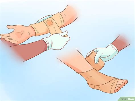 Cách để Điều trị Trật khớp: 9 Bước (kèm Ảnh) – wikiHow