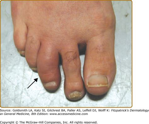 Psoriatic Arthritis Toes